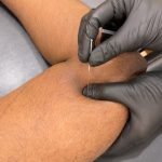 Dry Needling Therapy